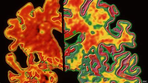 Cientistas Investigam Possibilidade De Alzheimer Ser Transmiss Vel