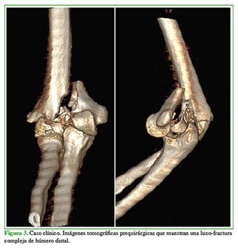 Vista De Osteos Ntesis De Fracturas Complejas De H Mero Distal Nuestra