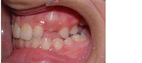 Extraction Timing Of Heavily Destructed Upper First Permanent Molars