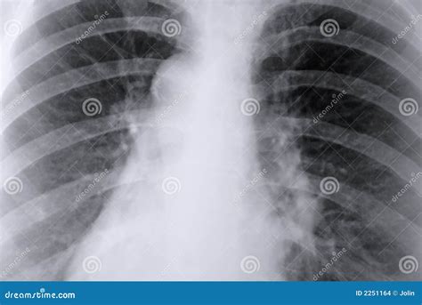 Thorax X-ray Of The Lungs Stock Images - Image: 2251164