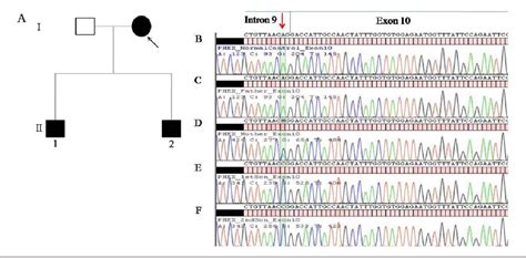 Figure 1 From Genetic Testing Confirmed The Early Diagnosis Of X Linked