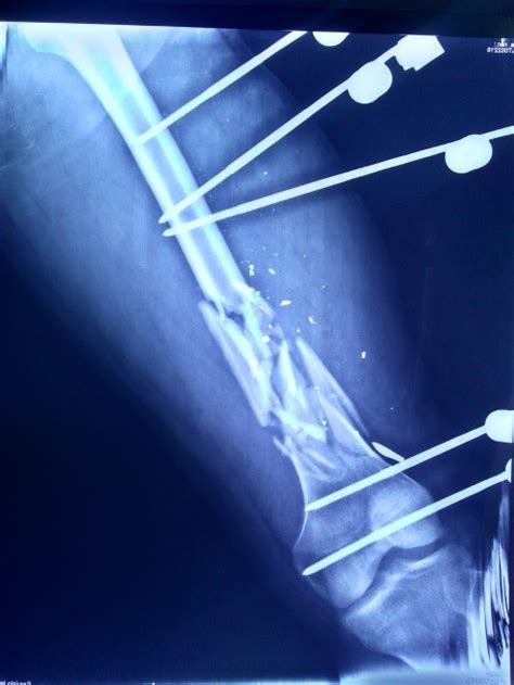 Fractura Conminuta Multifragmentada De Fémur Dr Jose Mario Dorantes