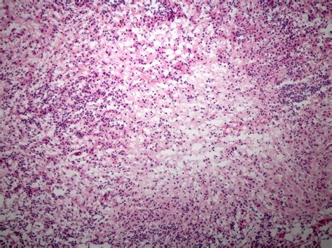 Pathology Outlines Tuberculosis