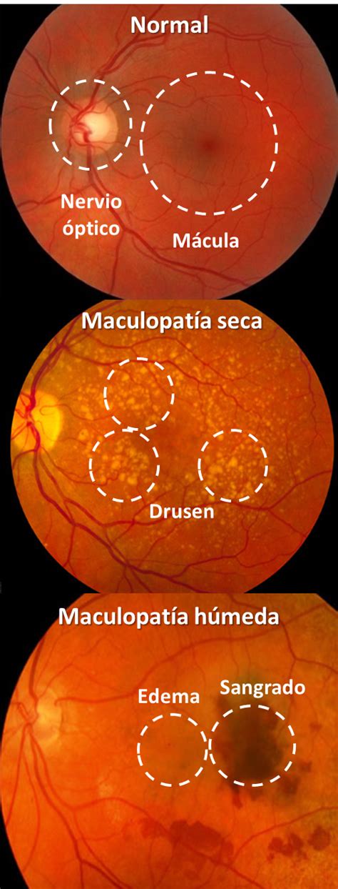 Qu Es La Degeneraci N Macular O Maculopat A Relacionada Con La Edad