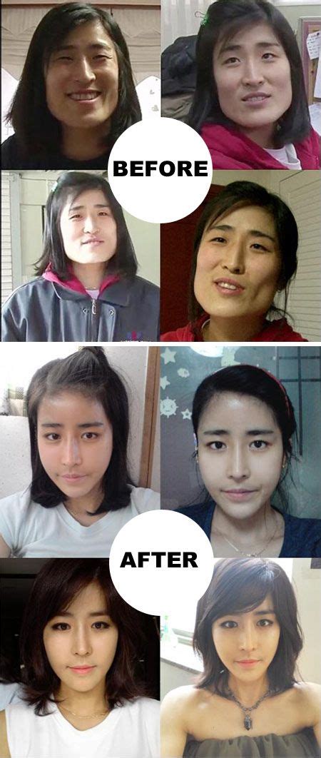 Before After Cosmetics Surgery