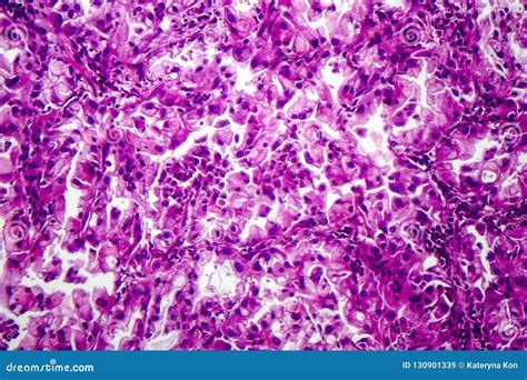 Histopathology Of Lung Cancer Stock Image Image Of Tumor Microscopy