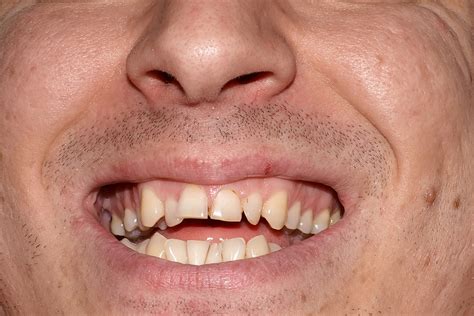 What Causes Crooked Teeth In Adults Wired Orthodontics