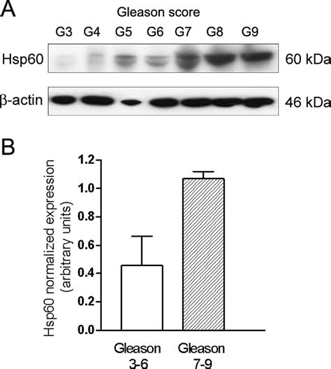 Immunohistochemical Expression Of Hsp60 Correlates With Tumor