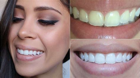 Clareamento De Dente A Laser Consulta Ideal