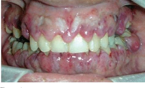 Figure 1 From Gingival Leukemic Infiltration As The First Manifestation