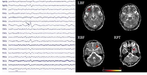 Eeg Fmri Multimodal Integration For Epilepsy Research Intechopen