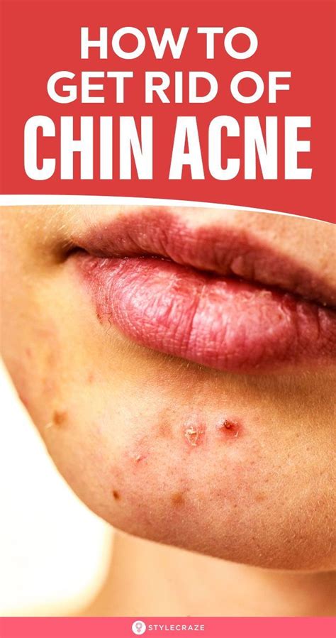 Chin Acne Pimples Causes Treatment And Skin Care Tips Artofit