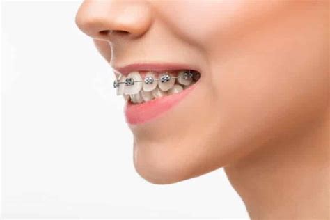 Overjet Vs Overbite Causes Effects And Treatments Brite Orthodontics