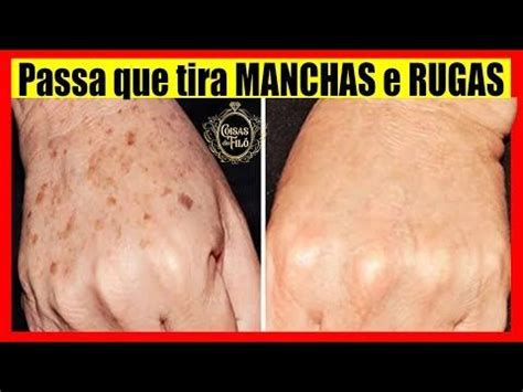 Como tratar mãos envelhecidas Veja 3 maneiras Slim Laser Tirar