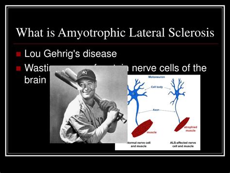 PPT Amyotrophic Lateral Sclerosis PowerPoint Presentation Free