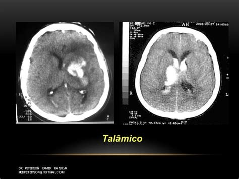 Hemorragia Intraparenquimatosa Hemorragia Cerebral Espontânea