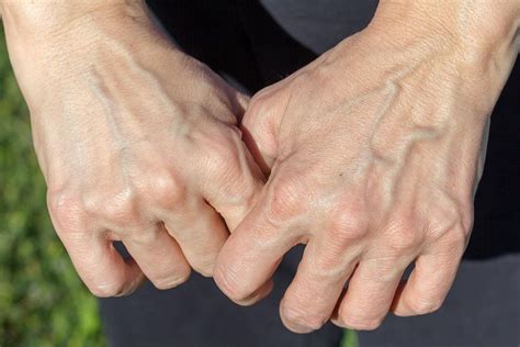 Hand Veins Wilton Ct And Fairfield Ct Center For Varicose Veins