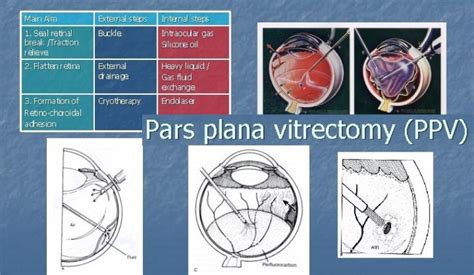 Vitrectomy Membrane Peeling