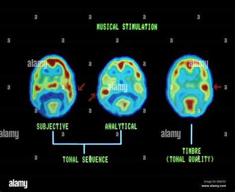 PET Scans Show Brain S Response To Musical Stimulation Stock Photo