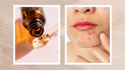 How to use vitamin C for acne, according to skin experts | Woman & Home