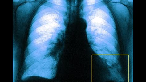 Qu est ce que l embolie pulmonaire bilatérale dont souffre Michel