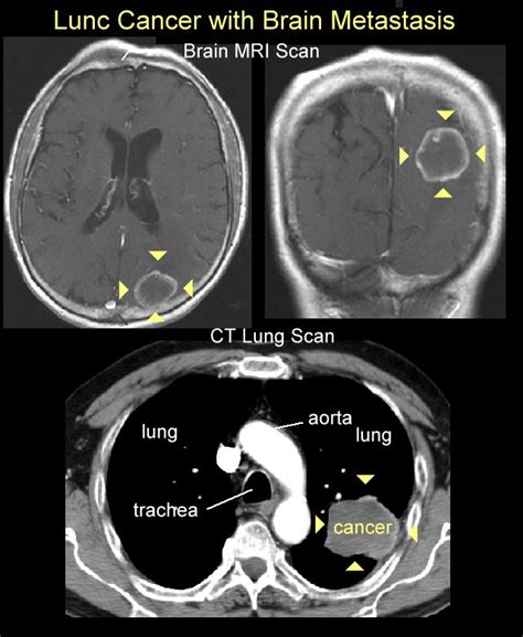 Prophylactic Cranial Irradiation For Patients With Small