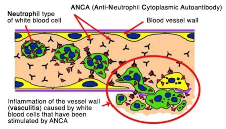 ANCA Related Vasculitis | Medical Junction