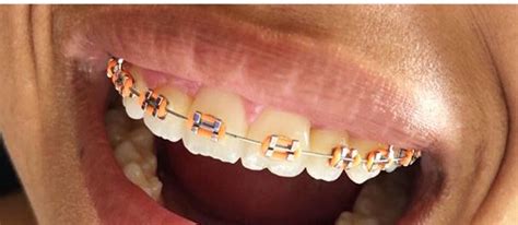 Best Braces Colors For Boys To Wear To Appeal To Girls Braces Explained