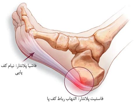 درد پاشنه پا ناشی از چیست و چگونه درمان میشود کلینیک طب فیزیکی دکتر