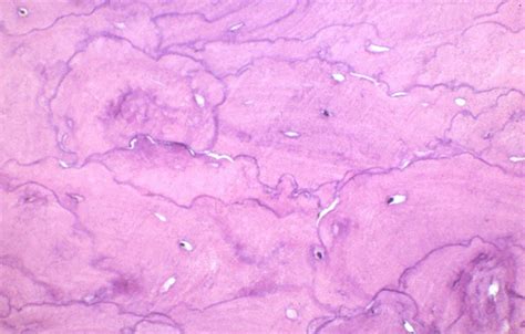 Paget S Disease Pathology Orthobullets