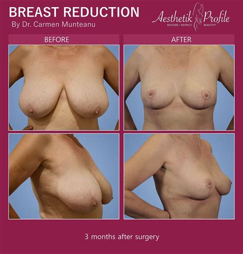 Breast Reduction Before After Photos Dr Carmen Munteanu