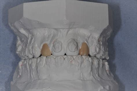 Esthetic And Functional Rehabilitation Of Peg‐shaped Maxillary Lateral