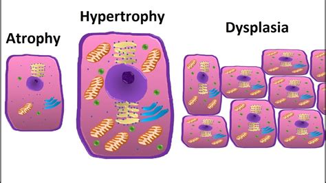 Cellular Adaptations Atrophy Hypertrophy Hyperplasia Metaplasia