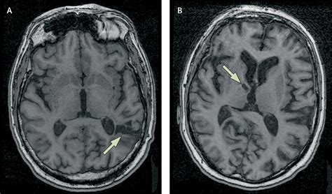 Old Lacunar Infarct On Mri