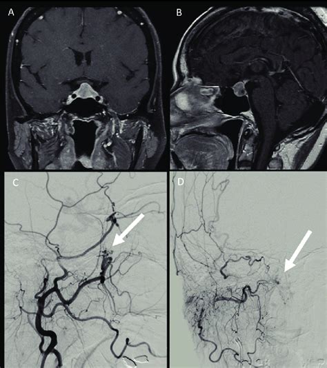 Pituitary tumor with suprasellar growth and involvement of optic ...