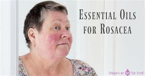 Essential Oils For Rosacea There S An Eo For That