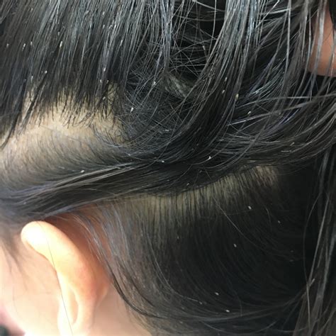 Lice In Hair Images