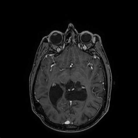 Intracranial Epidermoid Cyst Image