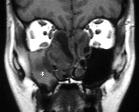 Imaging Features Of Invasive And Noninvasive Fungal Sinusitis A Review