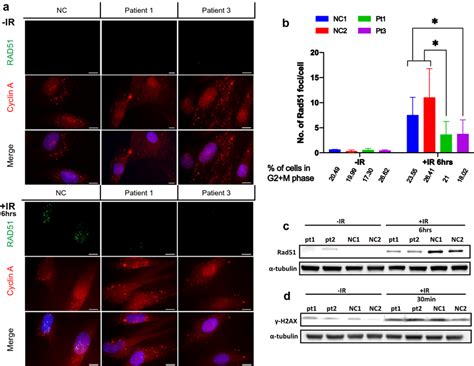 Rad Foci Formation Is Impaired In Patients Cells A Control And