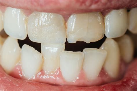 Overlapping Canine Teeth Unveiling The Causes And Impact On Your Smile