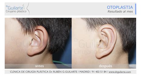 Otoplastia con hilos tensores Qué es y en qué consiste Dr Guilarte