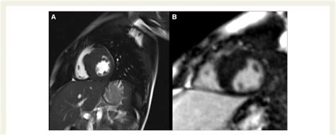 A Cardiac Magnetic Resonance Imaging Showing An Asymmetric Septal