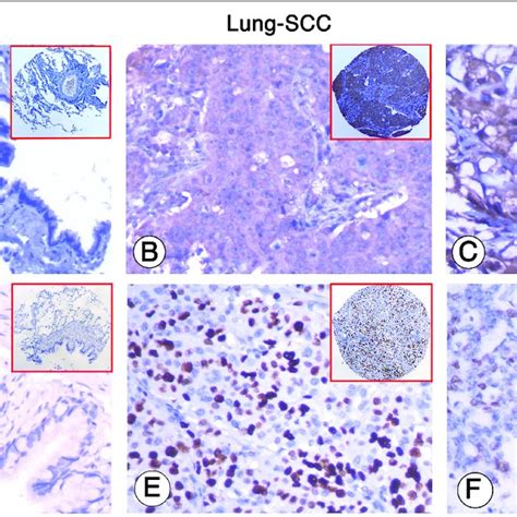 Analysis Of The Association Between Expression Of Mcl And Ki Pi