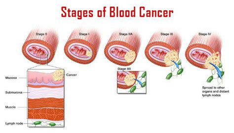 Blood Cancer Treatments Causes Symptoms Nhcancerclinics