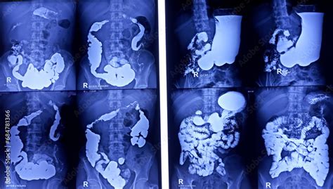 Barium Meal And Follow Through Examination X Ray Showing Digestive