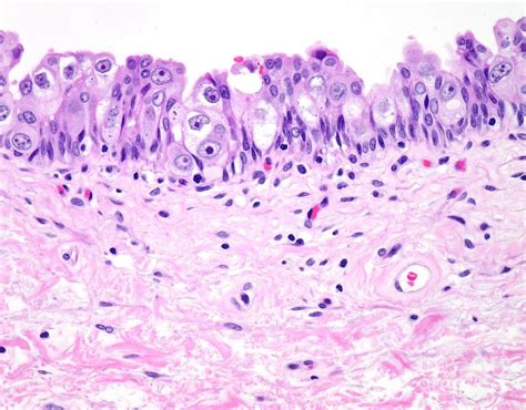 Urothelial Carcinoma In Situ Photograph By Webpathologyscience Photo Library