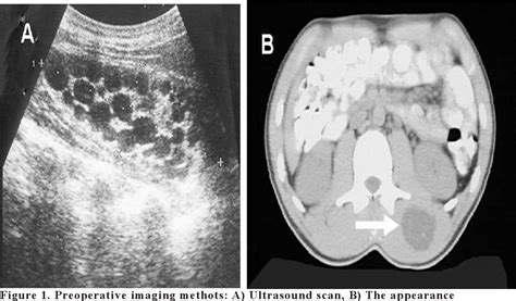 Pdf Primer Hydatid Cyst In Paravertebral Muscle Semantic Scholar