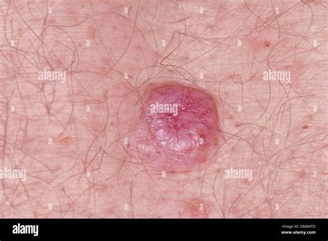 El Carcinoma De Células Basales Cáncer De Piel Close Up De Un