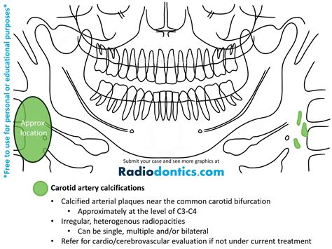 Panoramic Radiopacities - Radiodontics